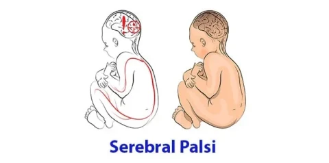 Serebral palsi belirtilerini simgeler ve çocuk figürüyle anlatan bilgilendirme görseli